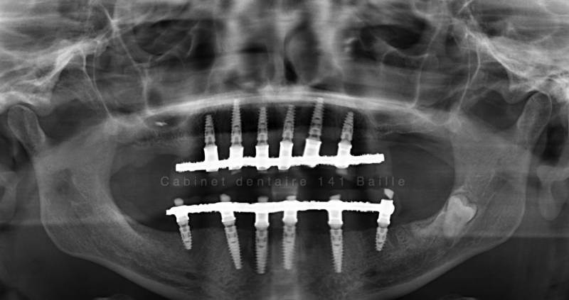 Chirurgie osseuse et greffe osseuses dentaire Marseille