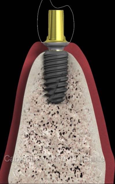 implants dentaires prix docteur didier tourrolier 141 baille marseille