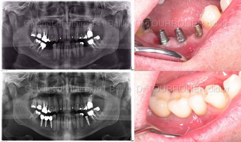 Remplacer une dent infectée par un implant.Dr Tourrolier 13005 Marseille.