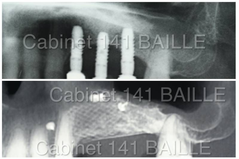 régénration osseuse guidée pour implants dentaires a marseille