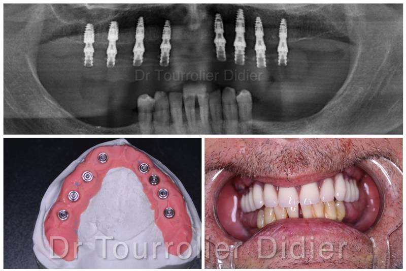 remplacer toutes ses dents par des implants en un jour