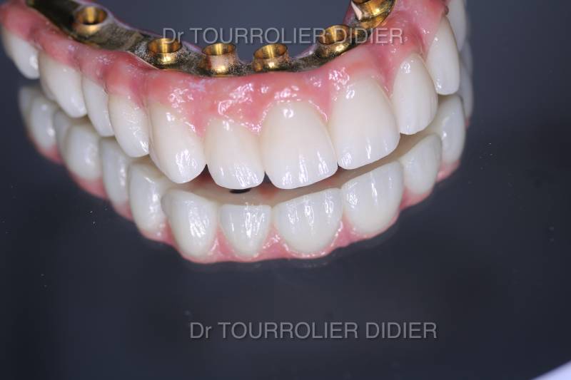 Meilleur spécialiste implant dentaire Avignon