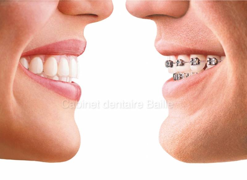 orthodontie sans bague métalliques au cabinet dentaire 141 baille du Docteur didier Tourrolier 13005 Marseille