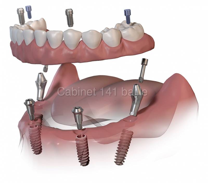 Spécialiste remplacement de toutes les dents par des implants à Marseille