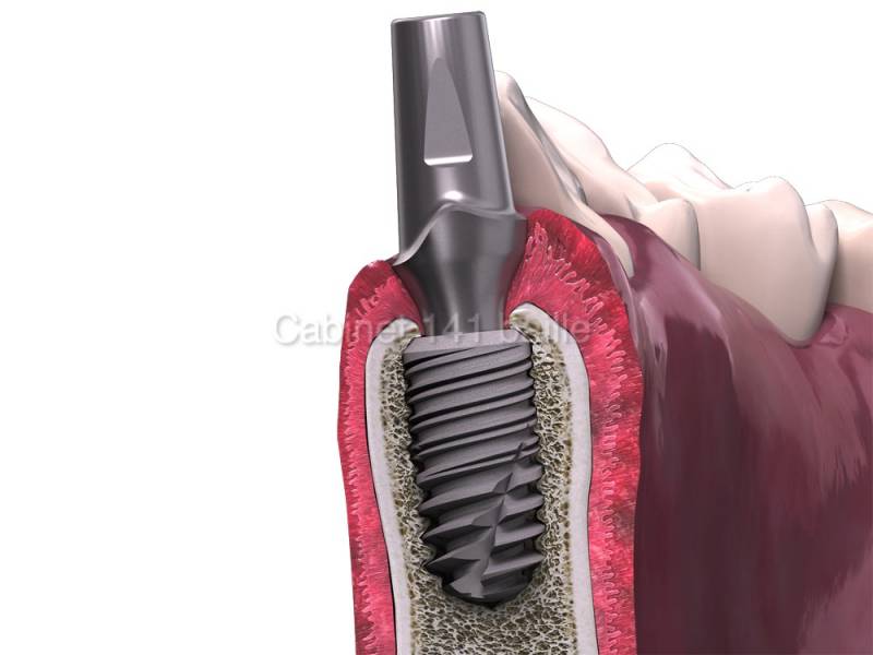 implant dentaire remplacement d'une dent par un implant docteur Tourrolier didier 13005