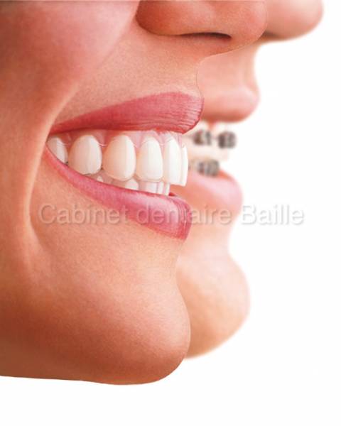 Traitement Orthodontique Esthétique par Gouttières Marseille