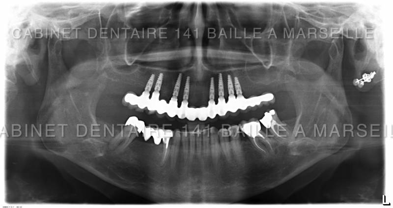 changer toutes ses dents par des implants marseille Cabinet dentaire 141 baille