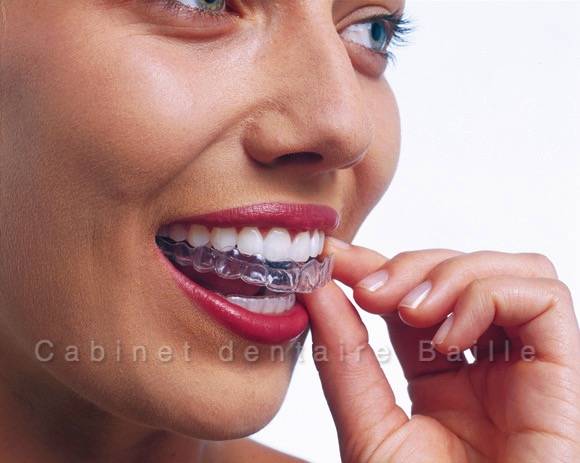 les gouttiières orthodontiques invisibles INVISALIGN® du cabinet dentaire 141 BAILLE .DR TOURROLIE