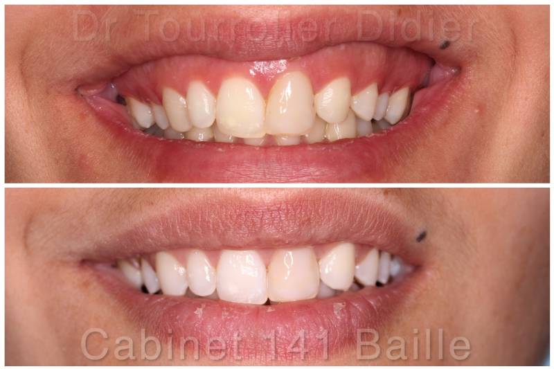 Sourire Gingival correction