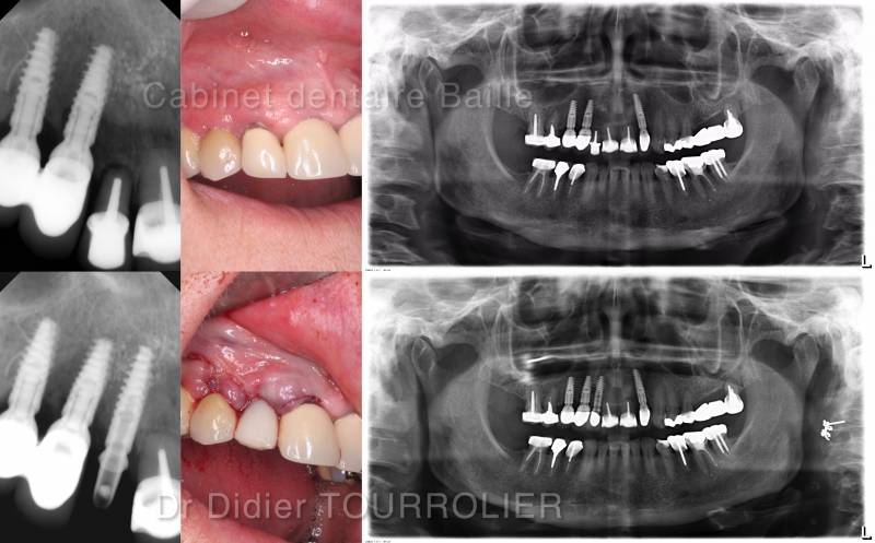 Remplacer immédiatement une dent par un implant.Dr TOURROLIER DIDIER 13005