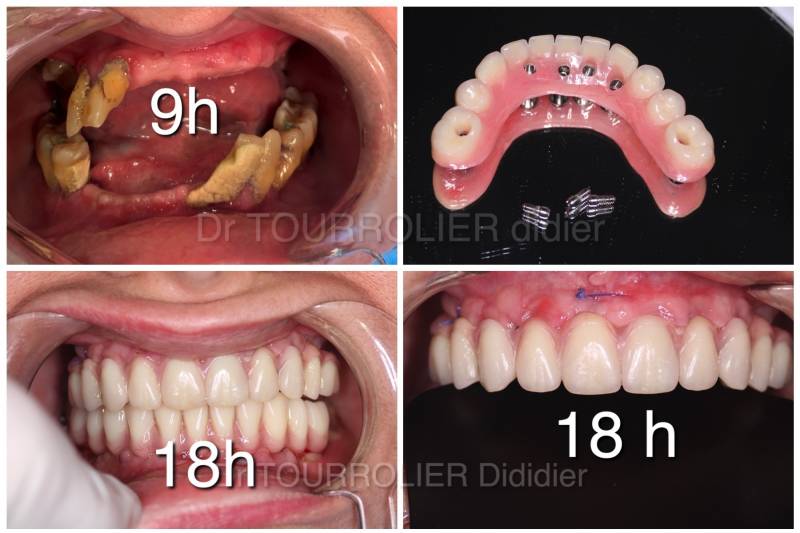 Spécialiste technique quattro implants dentaires Marseille
