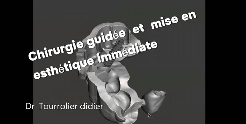 specialiste chrirugie implant dentaire guidée mise en esthétique immédiate 