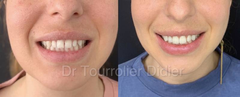 Alignement dentaire avec gouttière transparente Invisalign Toulon