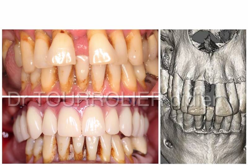 Remplacer ses dents par des implants.Dr Tourrolier implantologie.